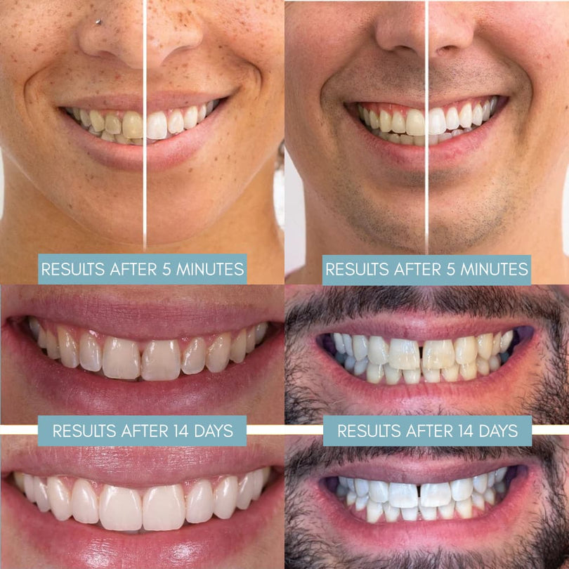 Teeth Whitening Pen Whitley